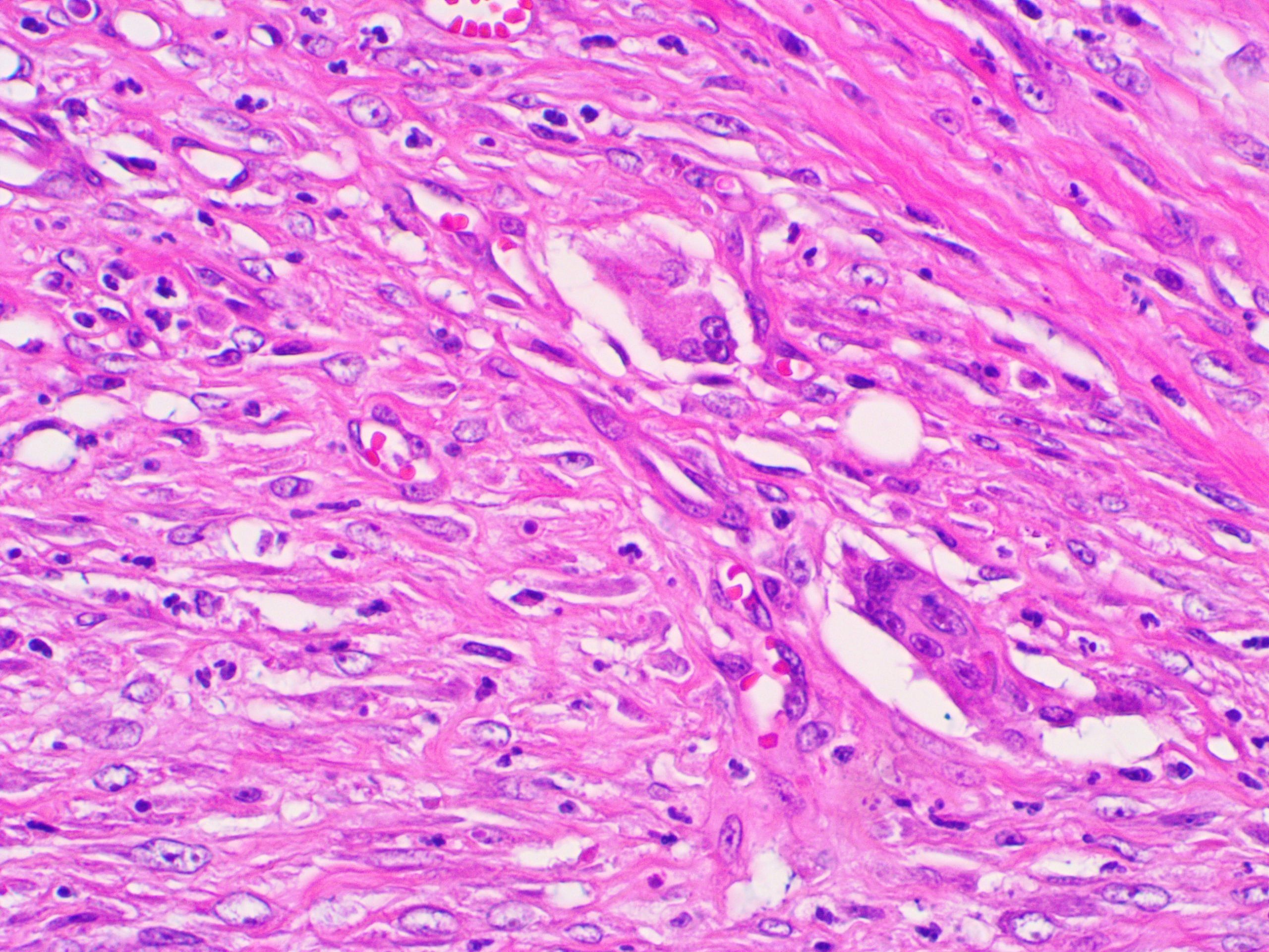 Cáncer asociado a enfermedades virales