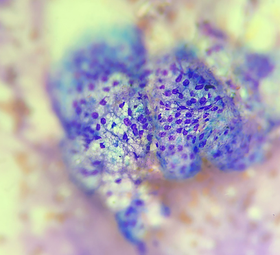 Diagnóstico de neoplasias epiteliales