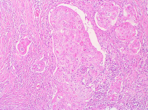 Diagnóstico de neoplasias epiteliales