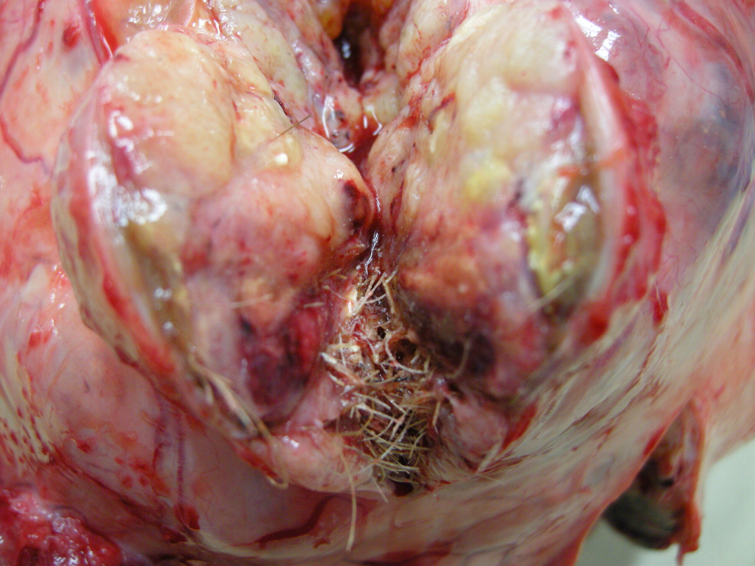 Teratoma Ovárico